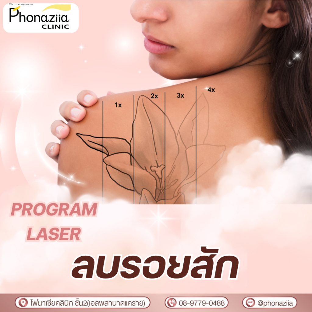 Phonaziiaclinic Laser Program