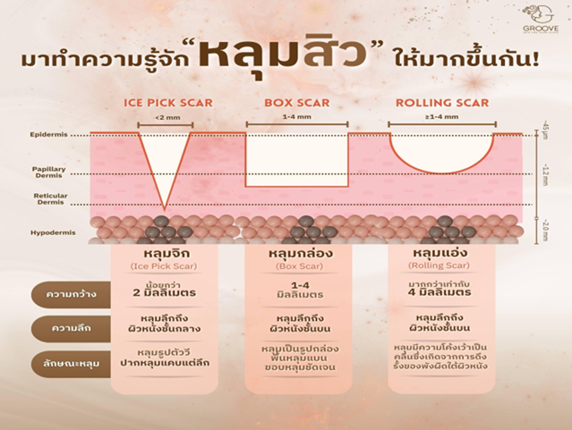 รู้จักหลุมสิว Phonaziiaclinic